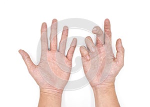 DupuytrenÃ¢â¬â¢s contracture in right hand compared to left normal one in Asian young man. It is a fibrosing disorder. photo